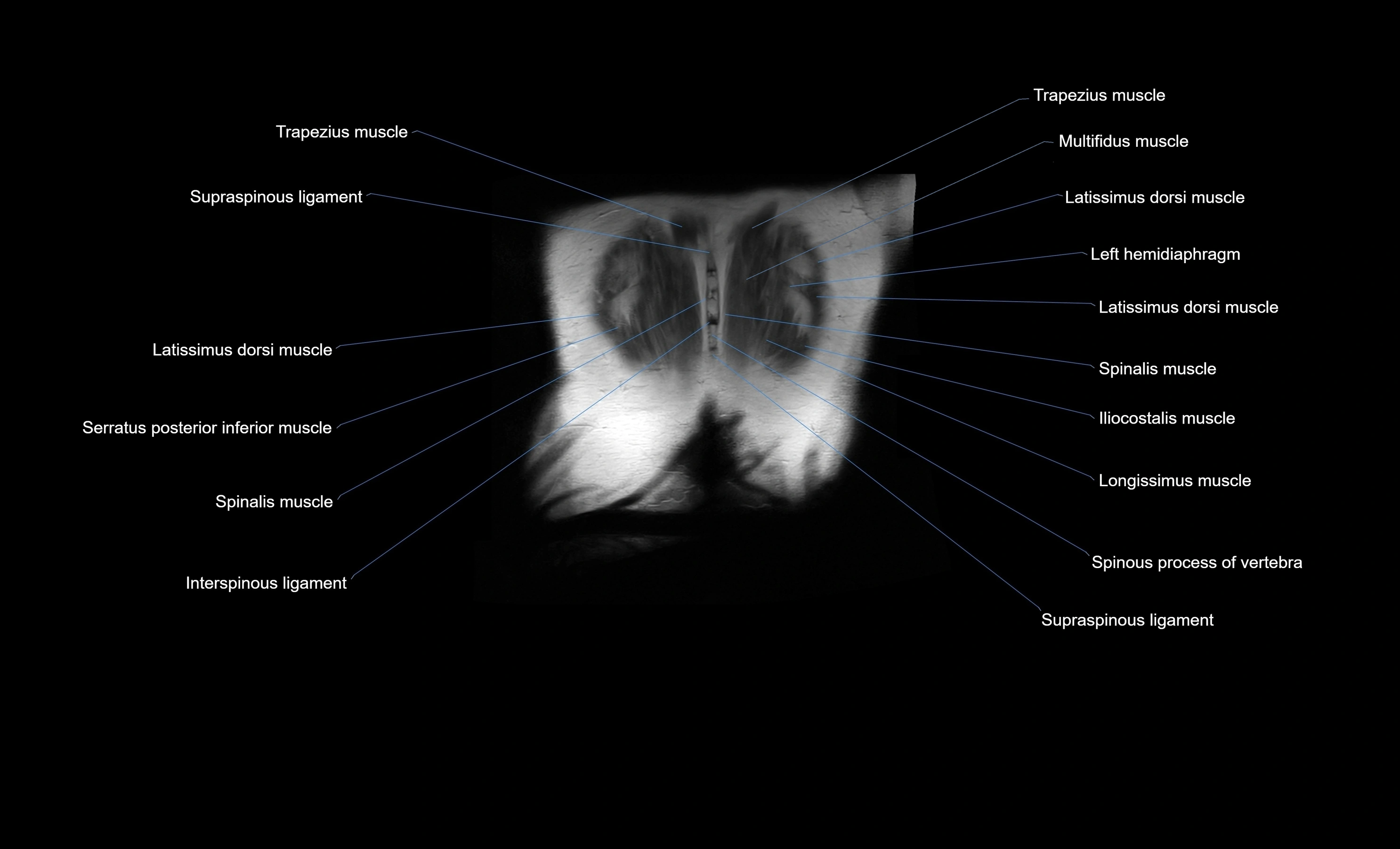 MRI Abdomen coronal labelled cross sectional anatomy radiology  image-img-00001-00056.webp